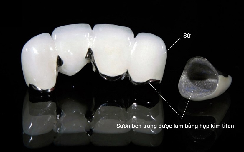 Răng sứ kim loại titan