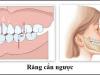 Điều trị khớp cắn ngược