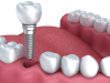 Những lưu ý sau khi cấy ghép Implant