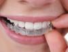 Có nên tẩy trắng răng tại nhà?