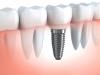 Tác dụng của việc cấy ghép implant