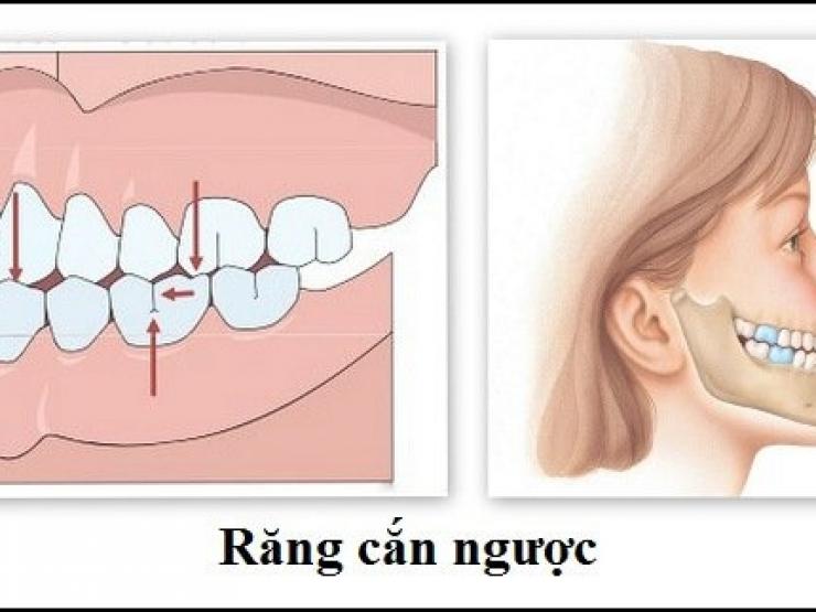 Điều trị khớp cắn ngược