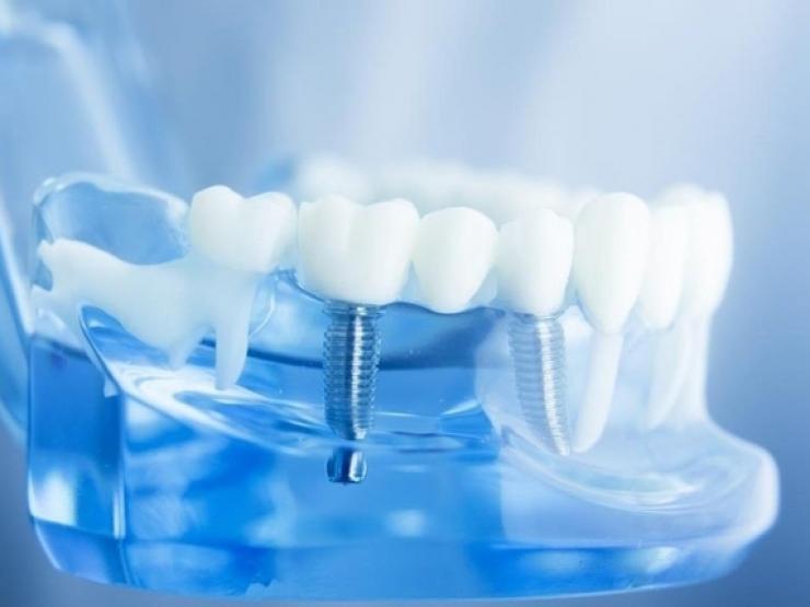 [KIẾN THỨC] Những trường hợp nên và không nên cấy ghép implant