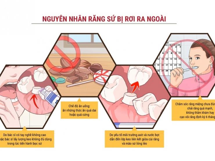 Răng sứ bị lung lay, bị rơi