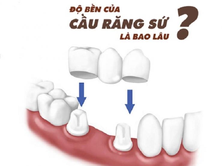 Kéo dài tuổi thọ của răng bọc sứ