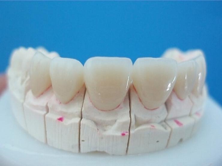 Răng sứ sử dụng được trong bao lâu