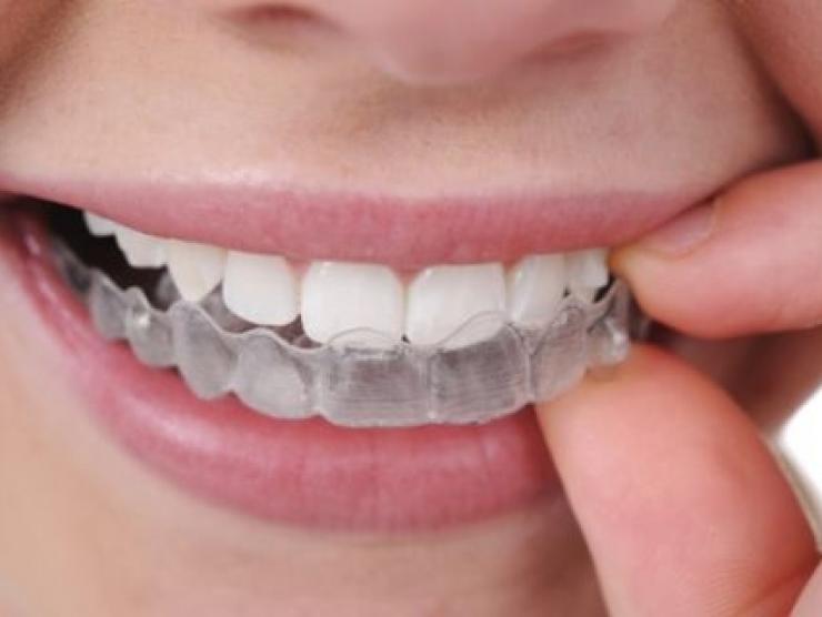 Có nên tẩy trắng răng tại nhà?
