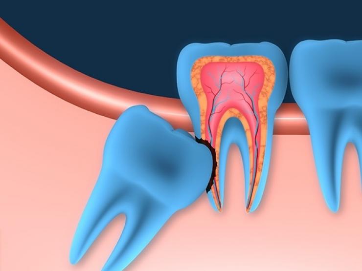 [KIẾN THỨC] Tác dụng của răng khôn