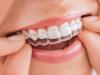 Thế nào là niềng răng trong suốt (Niềng invisalign) ?