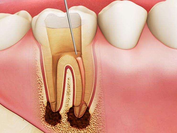 Tại sao nên điều trị tủy răng và chi phí?