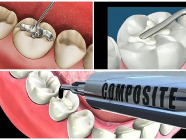 Các vấn đề sau khi trám răng