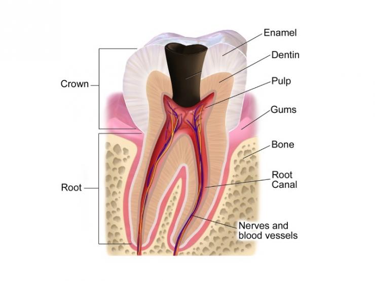 Dấu hiệu nhận biết bệnh viêm tủy răng