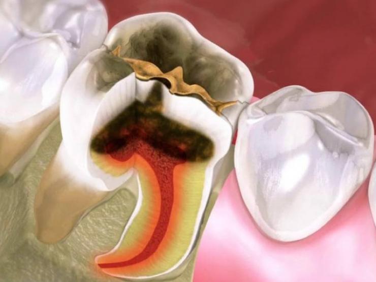 Các giai đoạn của viêm tủy răng
