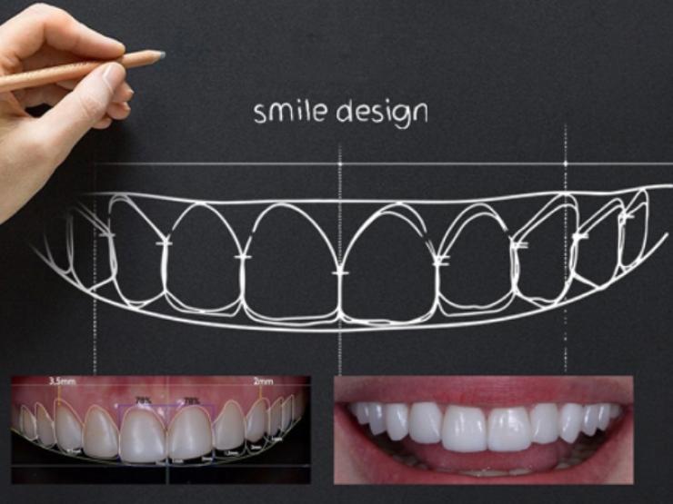 Những tiêu chí cần biết khi thực hiện thiết kế nụ cười