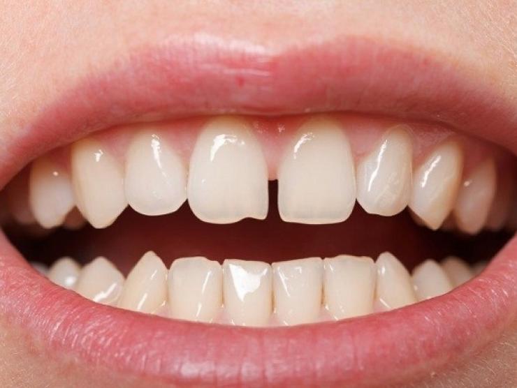 Quy trình trám răng thẩm mỹ