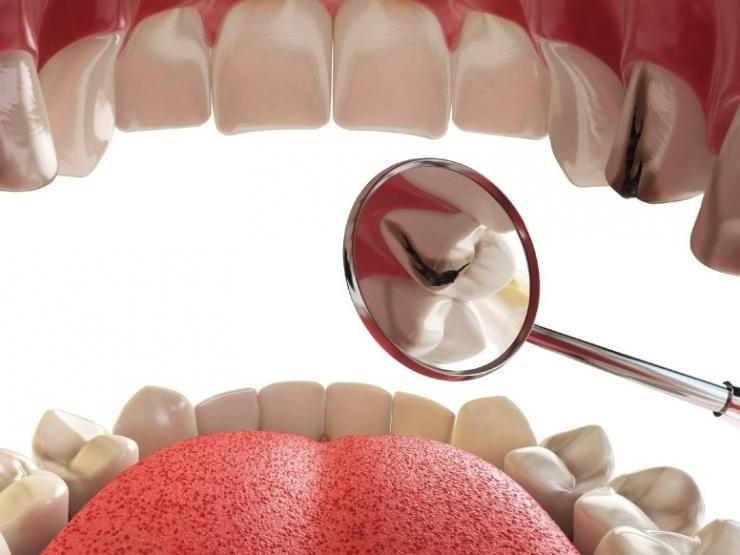 Tại sao nên trám răng và chi phí trám?