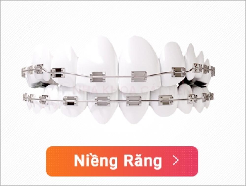 Niềng răng Mắc cài