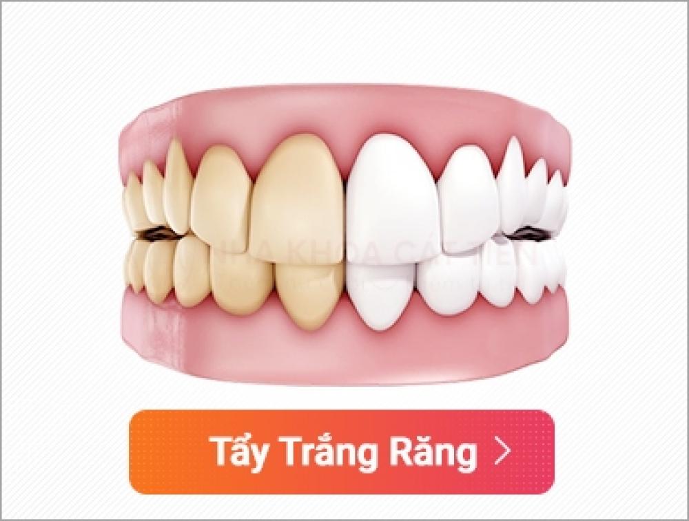 Tẩy trắng răng