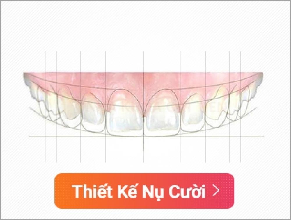 Thiết kế nụ cười