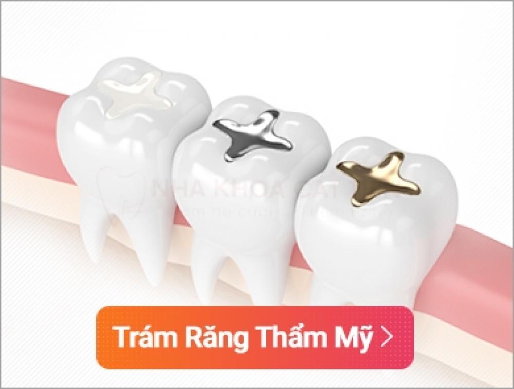 Trám răng thẩm mỹ