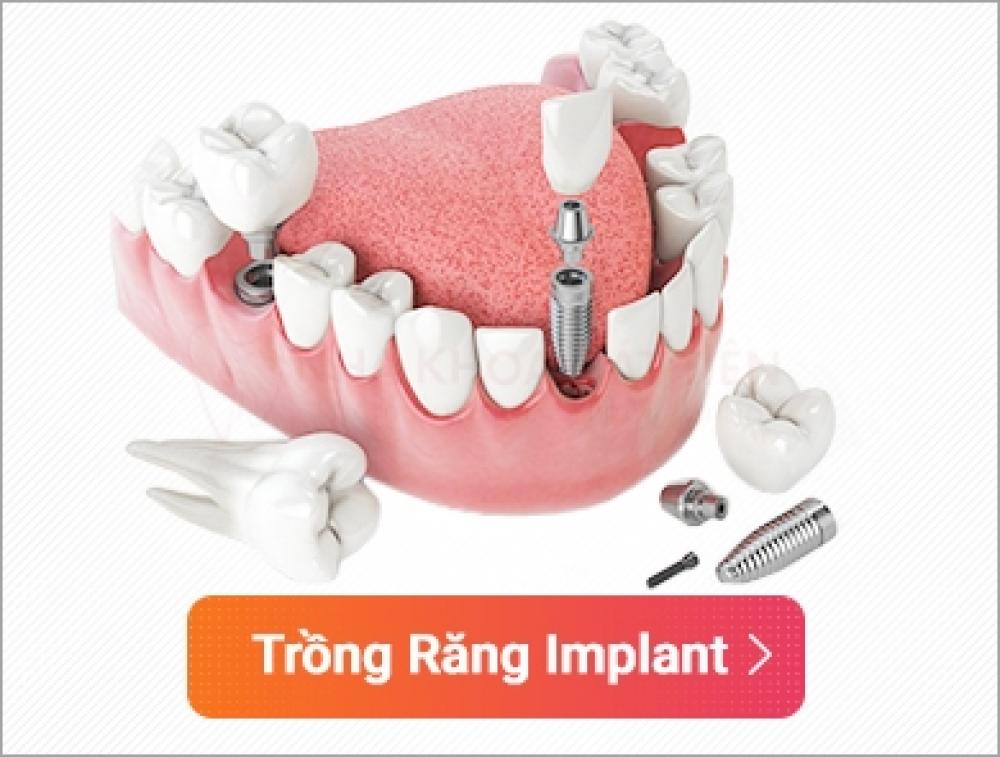 Trồng răng implant