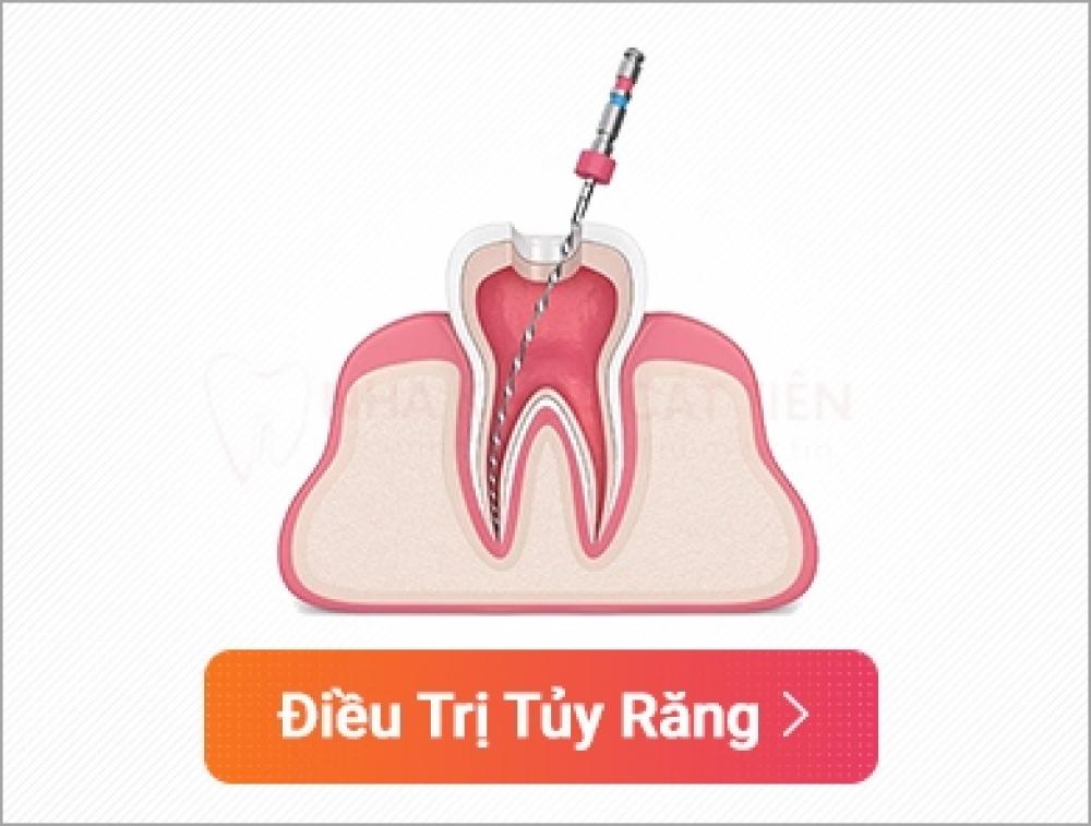 Điều trị tủy răng