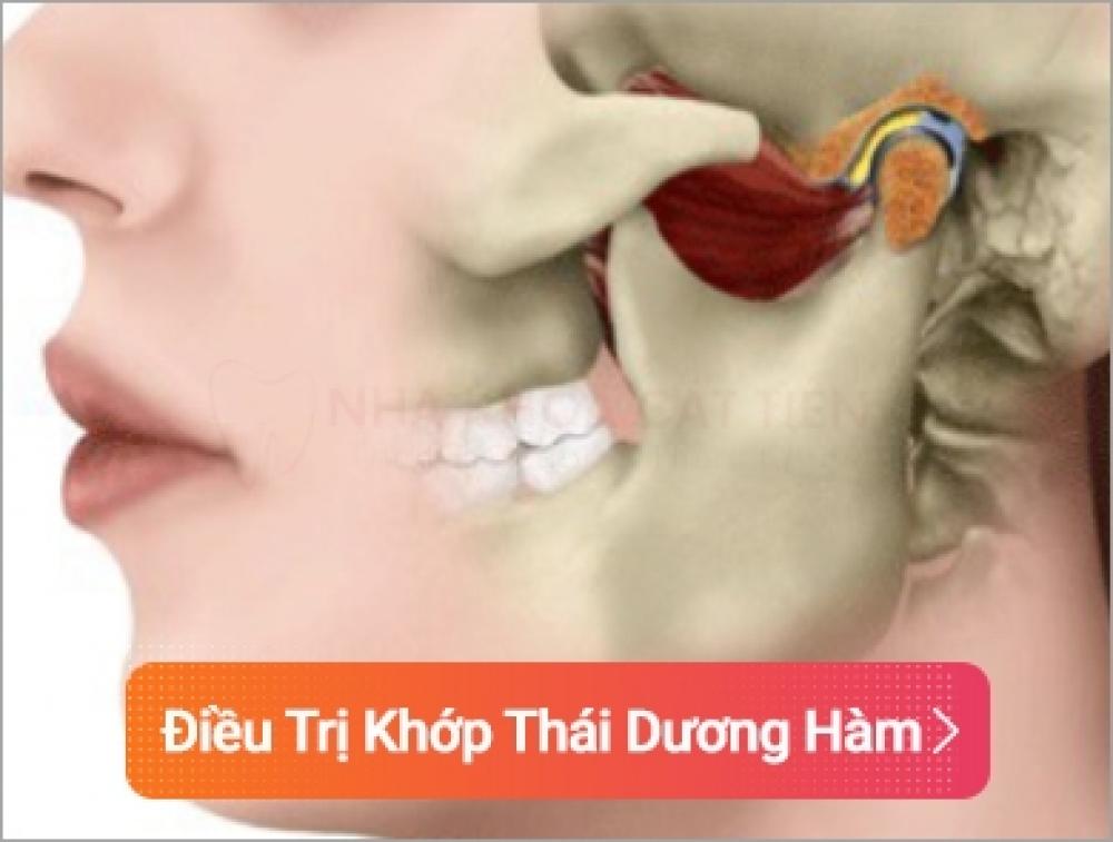 Viêm khớp thái dương hàm